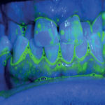 erosione-dentale_3i