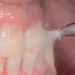erosione-dentale_4
