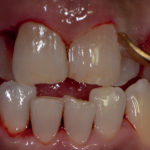 erosione-dentale_5a