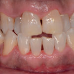 erosione-dentale_5b