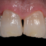 erosione-dentale_7