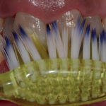 erosione-dentale_8a