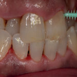 erosione-dentale_8b