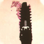 riabilitazione-implantare