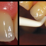 riabilitazione-implantare1