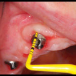 riabilitazione-implantare2