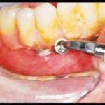 riabilitazione-implantare3