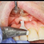 riabilitazione-implantare4