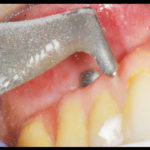riabilitazione-implantare5