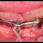 riabilitazione-implantare8