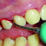 Fig. 6 Per il controllo del dolore è stato applicato un anestetico topico in gel abase di lidocaina e prilocaina; per rimuovere il tartaro subgingivale è stato utilizzato l’inserto Slimline 30 K 10 LR Curve.  Per il controllo del dolore è stato applicato un anestetico topico in gel abase di lidocaina e prilocaina; per rimuovere il tartaro subgingivale è stato utilizzato l’inserto Slimline 30 K 10 LR Curve.
