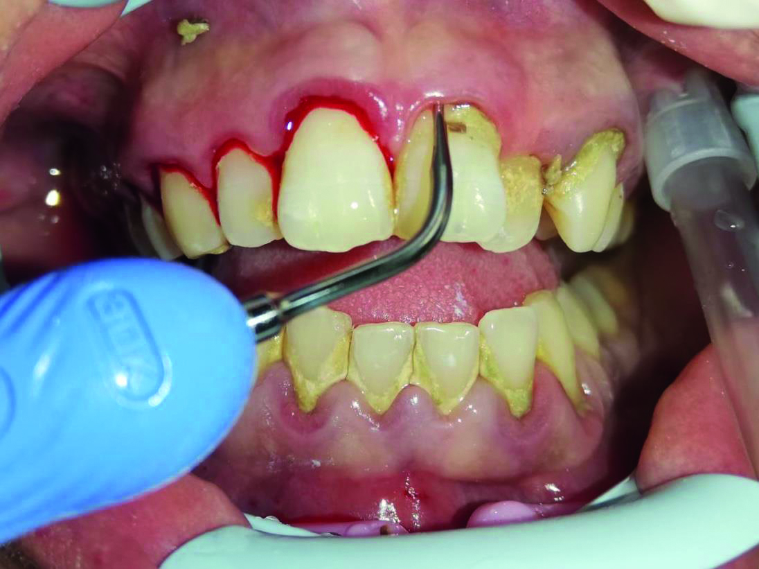 Fig. 1 All'esame clinico si notano depositi di tartaro e gengive edematose.