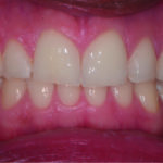 Fig. 3 Osservazione clinica e delle condizioni degli allineatori.