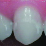 Fig. 5 Ingrandimento con videocamera intraorale delle  white spot.