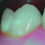 Fig. 6 Ingrandimento con videocamera intraorale delle  white spot.