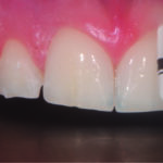 Fig. 7 Valutazione delle caratteristiche anatomiche e del biotipo tissutale del cavo orale.