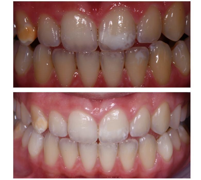 Fig. 6: Confronto Pre e Post trattamento a 5 mesi