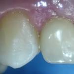 Foto post trattamento  sbiancante dell’elemento 13.