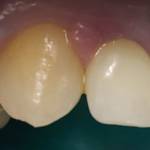 Foto pre trattamento  sbiancante dell’elemento 13.