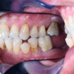 Fig. 1C Fotografia intraorale  laterale