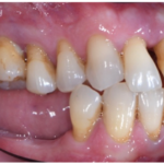 Fig. 1A Fotografia intraorale laterale