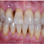 Fig. 1B Fotografia intraorale vestibolare