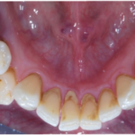 Fig. 2B Fotografia intraorale linguale