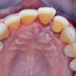 Fig. 2A Fotografia intraorale palatale