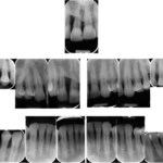 Fig. 8 Status completo di endorali: rivalutazione 2 anni.