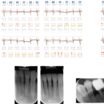 Fig. 9 Cartella parodontale e radiografie dei siti significativi: rivalutazione 3 anni.