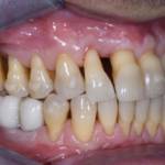 Fig. 10A Fotografia intraorali laterale a 3 anni