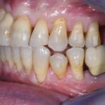 Fig. 10C Fotografia intraorali laterale a 3 anni