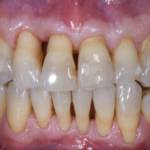 Fig. 10B Fotografia intraorali vestibolare a 3 anni