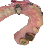 Disinclusione canino con ortodonzia.