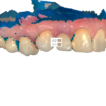 Scansione per presa colore post trattamento A2.