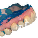 Presa colore per confronto con corona artificiale.