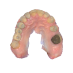 Scansione finale arcata superiore post trattamento ortodontico e sbiancamento.