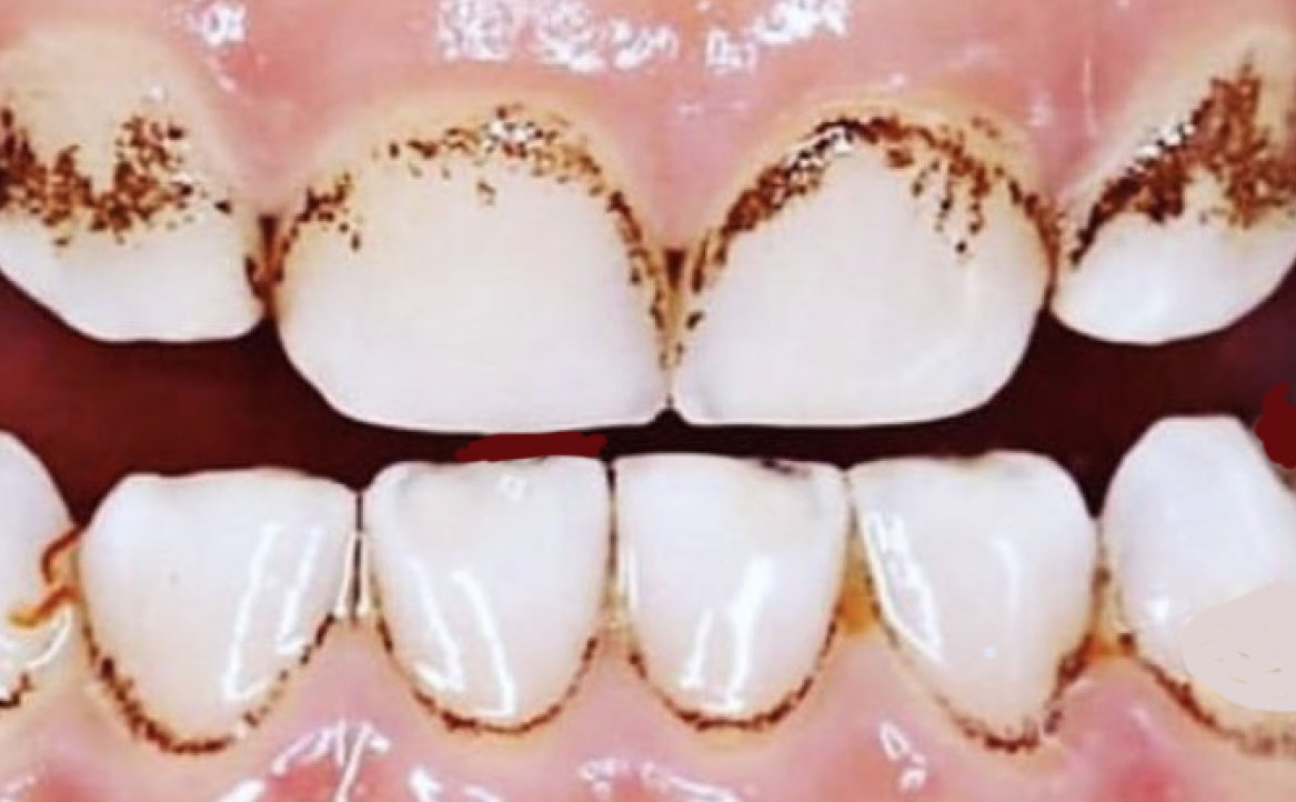 Nell'immagine sotto un esempio di black stain nelle arcate anteriori (Partynia, CC BY-SA 4.0 , via Wikimedia Commons)