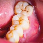 Nell’immagine un esempio di black stain nei denti posteriori.