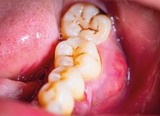 Nell'immagine un esempio di black stain nei denti posteriori.