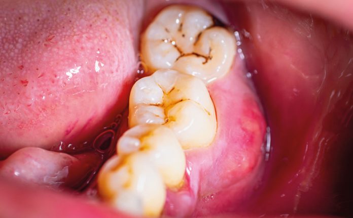 Nell'immagine un esempio di black stain nei denti posteriori.