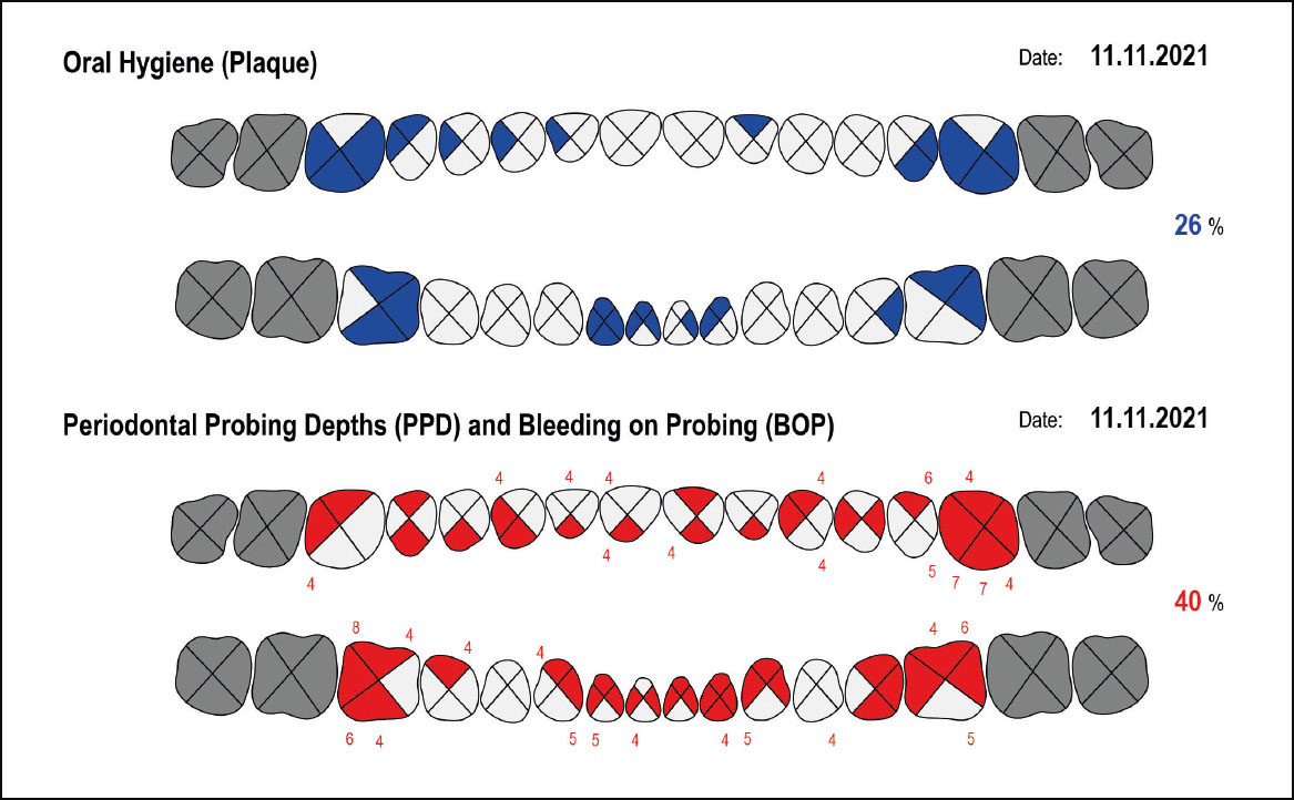 Fig. 1 Nella foto un esempio di dati forniti dagli strumenti in dotazione agli igienisti dentali (https://periodontalchart-online.com/it/).