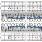 Fig. 4 Nella foto un esempio di dati forniti dagli strumenti in dotazione agli igienisti dentali (https://periodontalchart-online.com/it/).