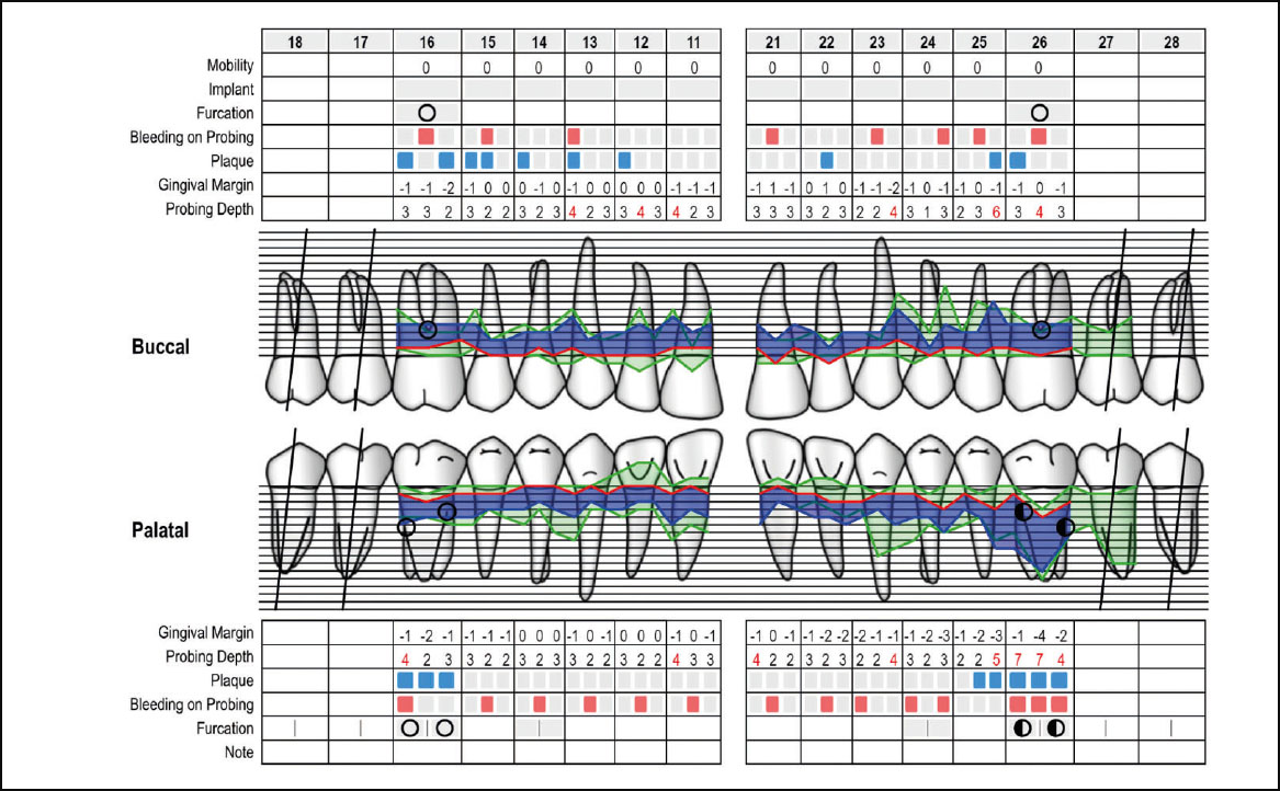 Fig. 4 Nella foto un esempio di dati forniti dagli strumenti in dotazione agli igienisti dentali (https://periodontalchart-online.com/it/).