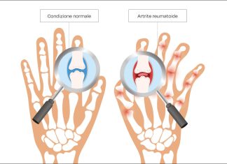 Fig. 1 L’artrite reumatoide.