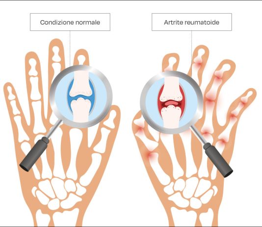 Fig. 1 L’artrite reumatoide.