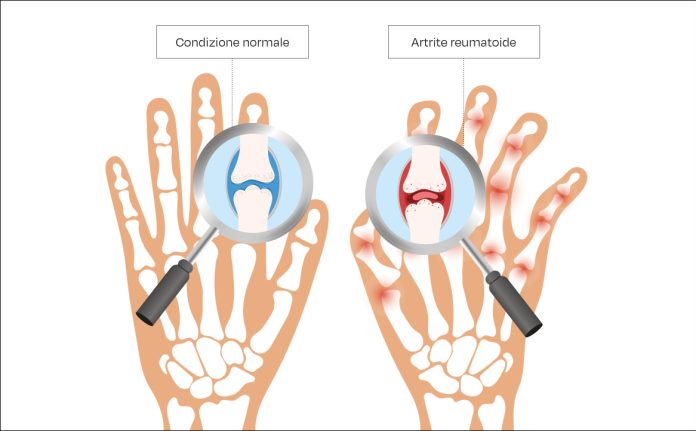 Fig. 1 L’artrite reumatoide.