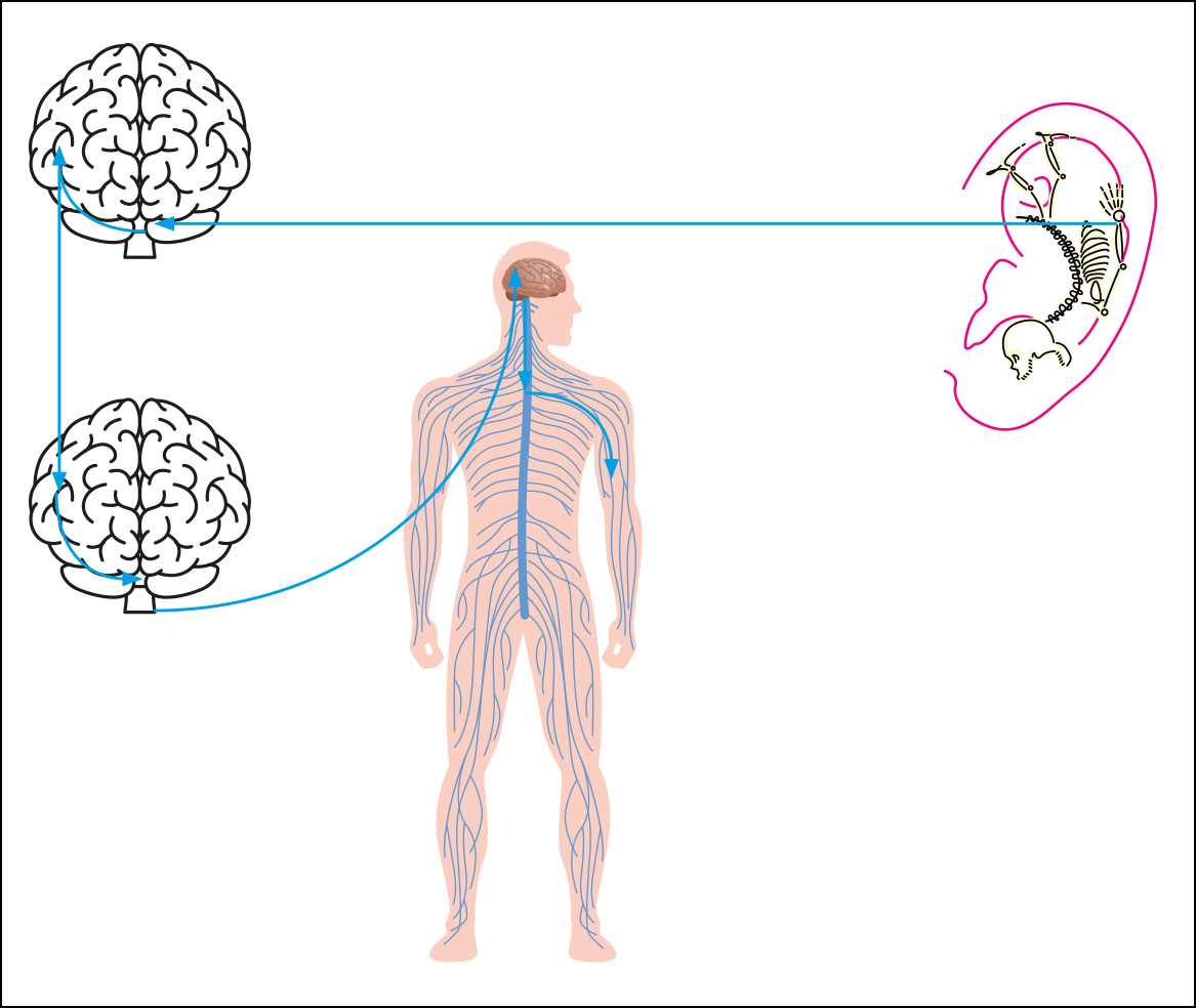 Fig. 4 Effetto riflesso della stimolazione auricolare.