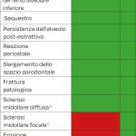 Tab. 3B Segni radiologici di MRONJ. * Sclerosi midollare focale con disorganizzazione trabecolare e scarsa differenziazione cortico midollare.