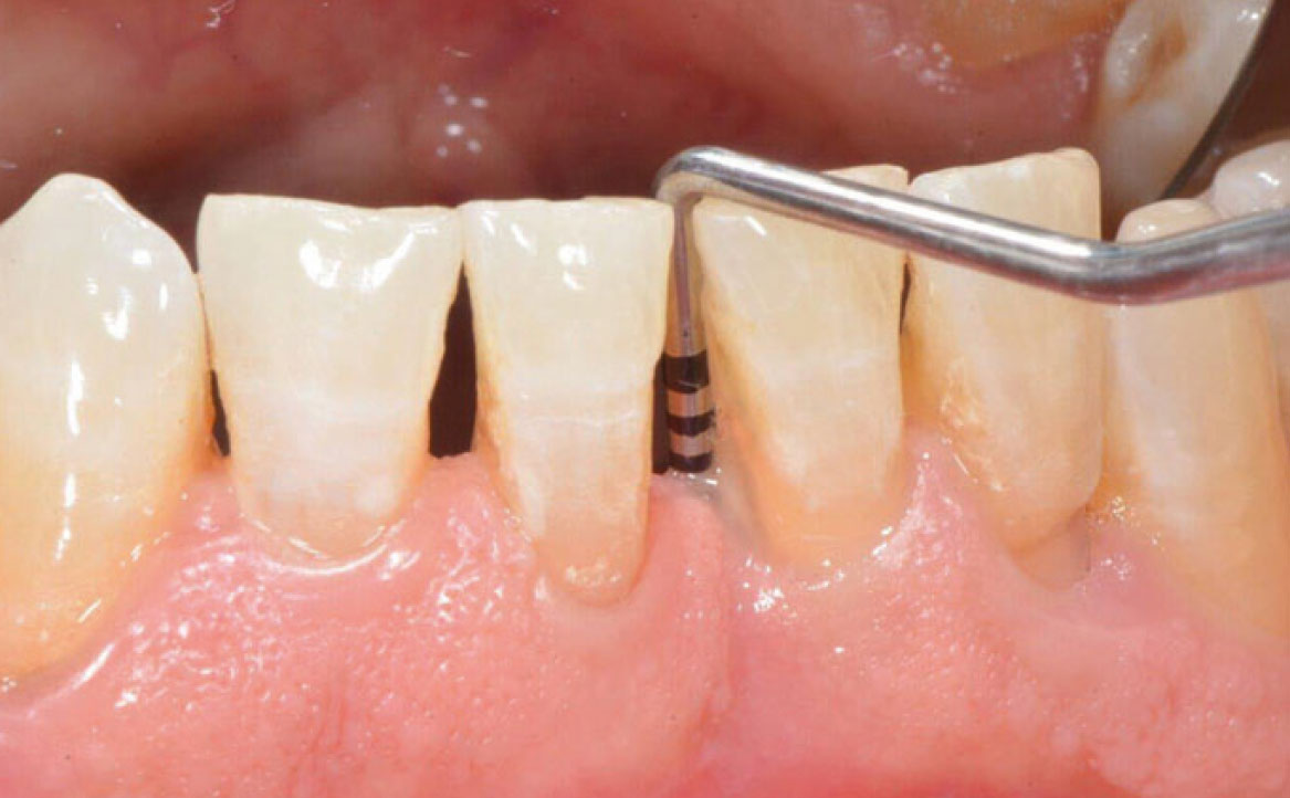 Fig. 4 Gruppo controllo I terapia farmacologica baseline.